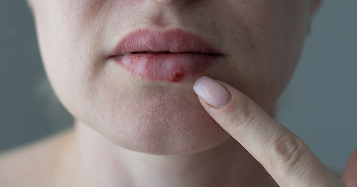 HOVILPRI, el antiviral oral que devuelve una opción a los pacientes con herpes que ya no responden a nada