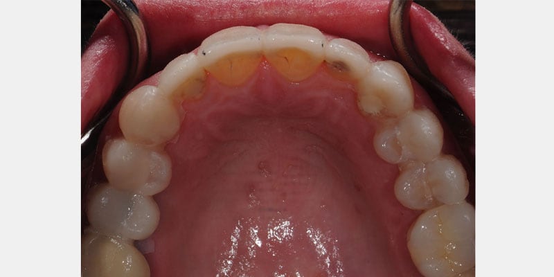 Carillas dentales: las filtraciones silenciosas que pueden arruinar una sonrisa desde adentro
